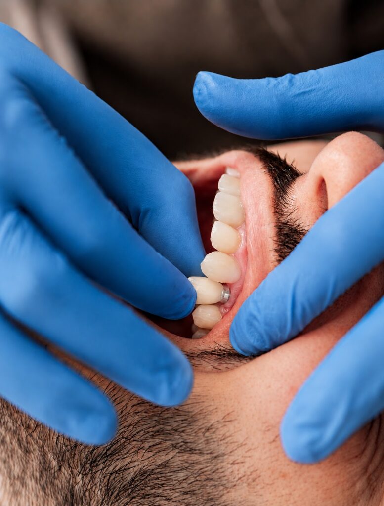 Especialista mostrando un modelo dental con implantes