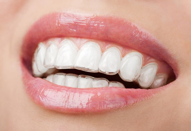Sonrisa con alineadores transparentes